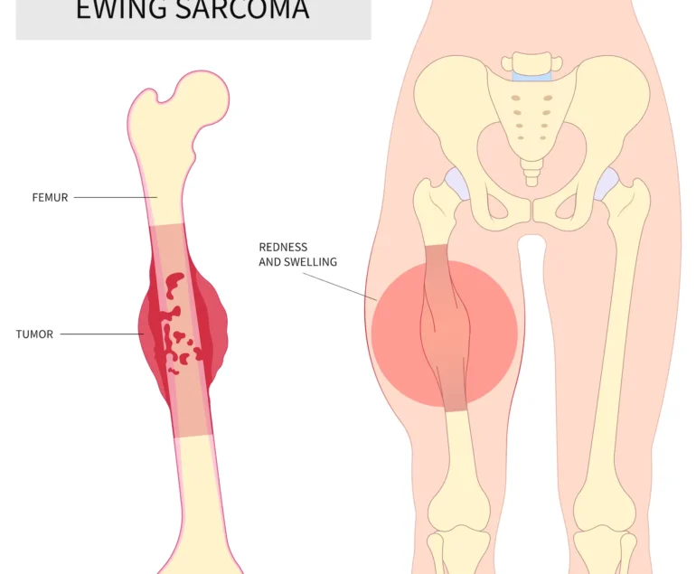 Ewing's-sarcoma