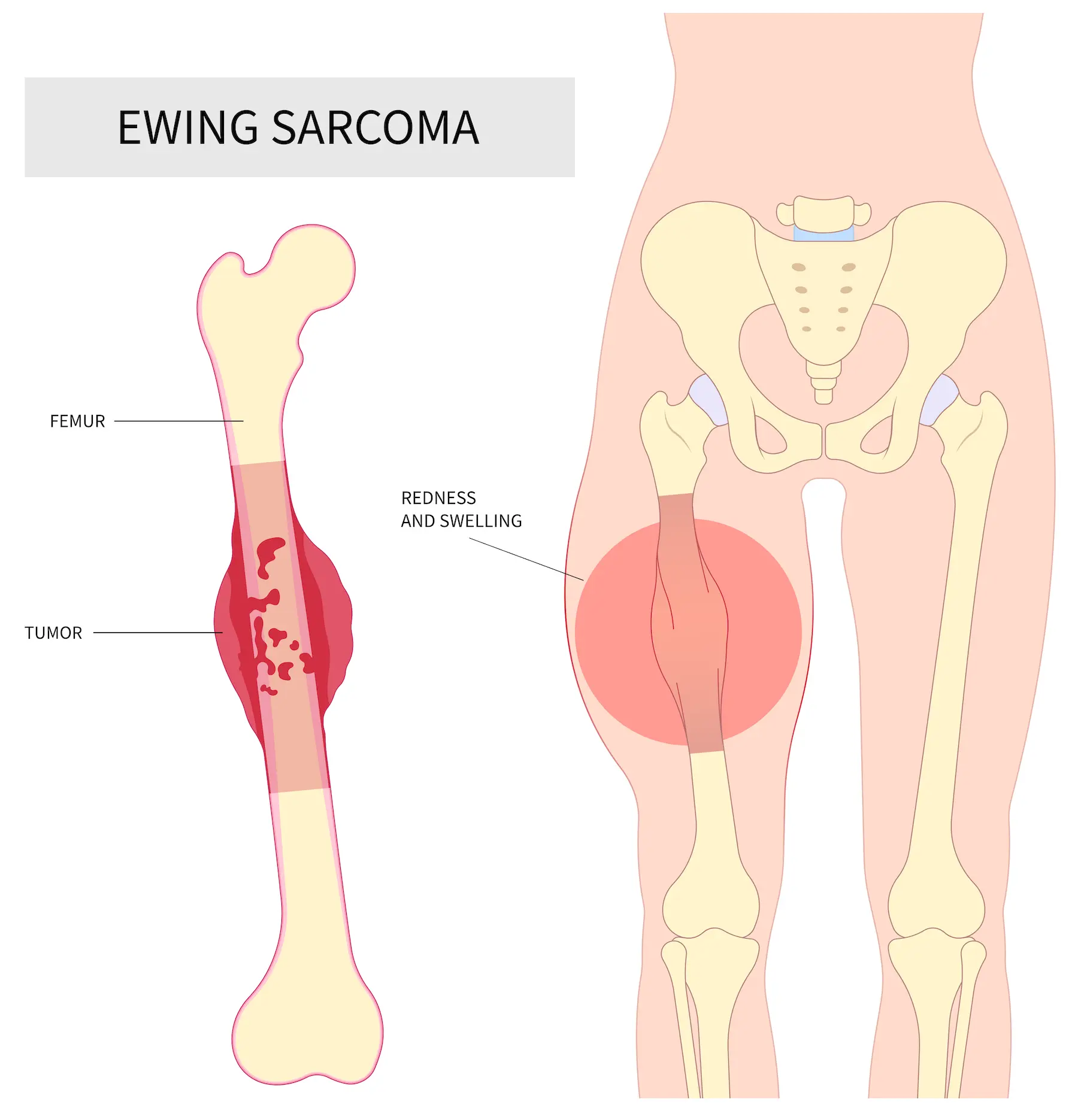 Ewing's-sarcoma