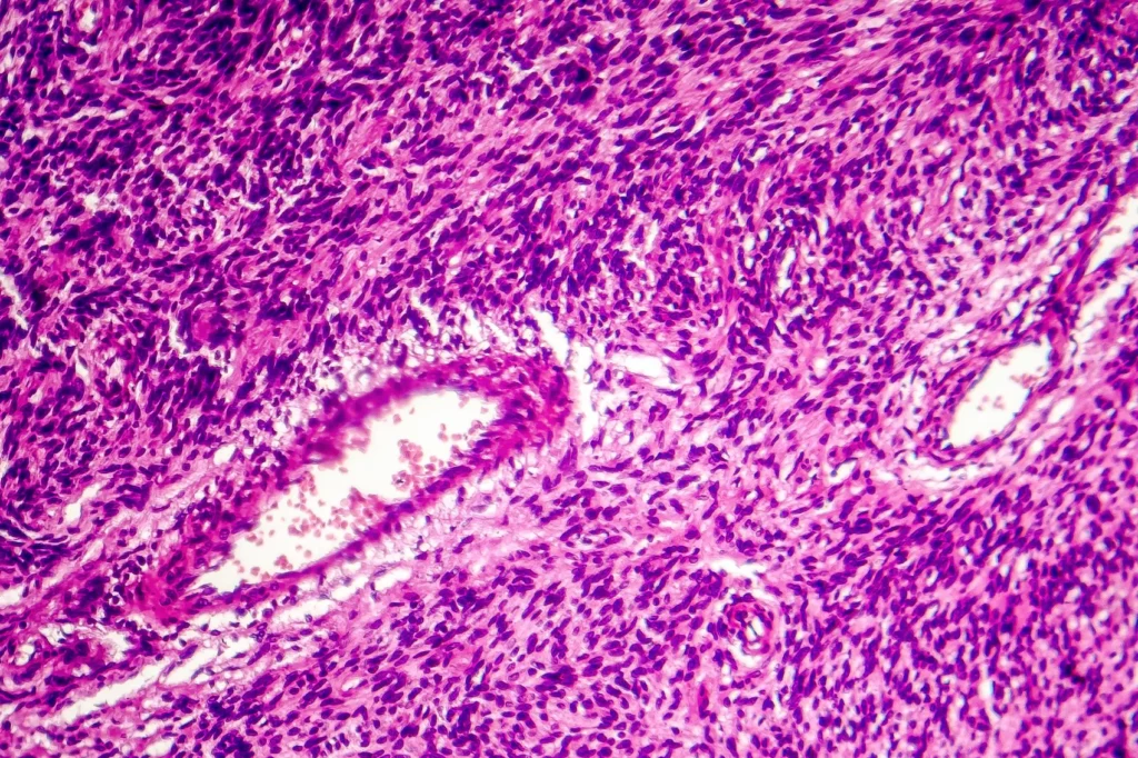 Fibrosarcoma