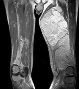 Liposarcoma-of-the-thigh