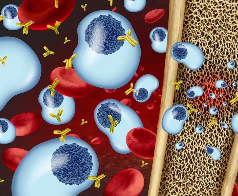 Multiple-Myeloma